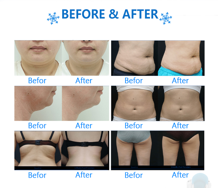 https://www.sincoherenbeaut.com/cryolipolysis-coolsculpting-machine/