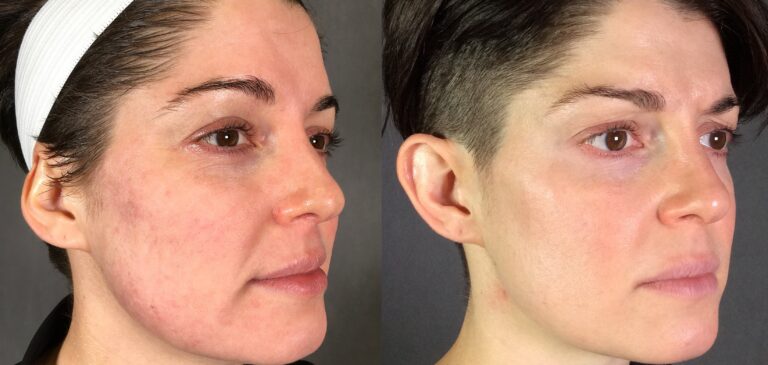 Secret-RF-Acne