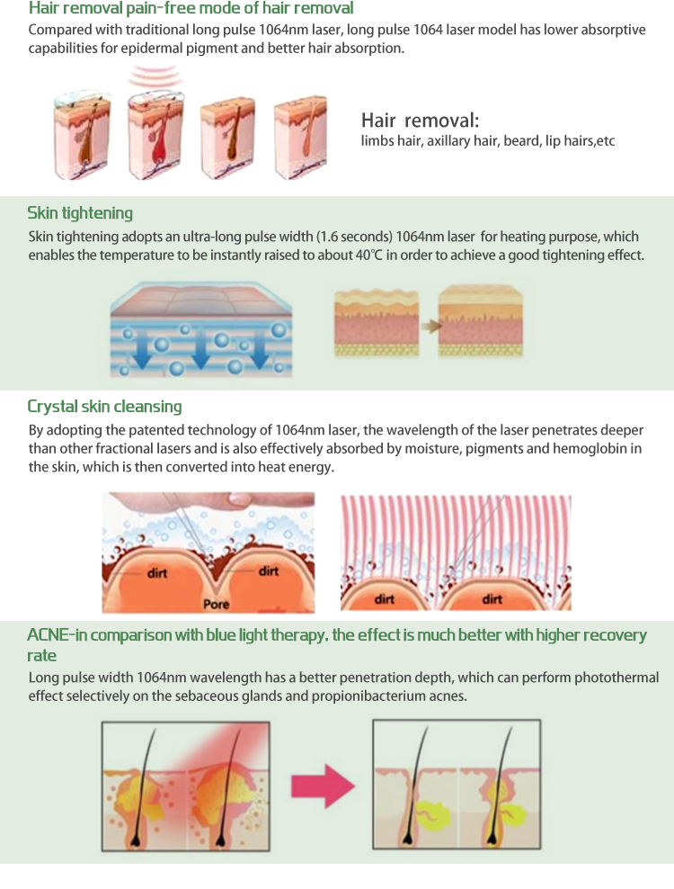 https://www.sincoherenbeaut.com/alex-yag-laser-hair-removal-machine-1064nm-755nm-product/