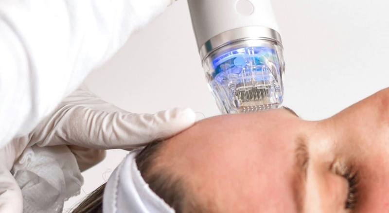 rf microneedle treatment