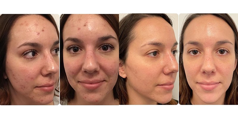 hydrafacial_avant-apres